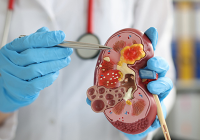 KIDNEY DISEASES